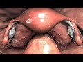 3D Medical Animation: Diagnostic Pelvic Laparoscopy