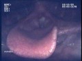 This is a transnasal endoscopic laryngeal video stroboscopic examination. We utilize small video recording equipment to visualize the voice box (larynx), the base of the tongue, and vocal cords. During this exam we pay very close attention to the vocal cords and their movement during this examination. This exam is narrated. This was performed by the physicians at Northwest ENT and Allergy Associates, with offices in Marietta, Woodstock, and Canton, Georgia