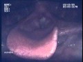 Endoscopic Laryngeal Video Stroboscopic Exam