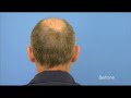 Hair Transplant | Results - 7218 Grafts - Hasson & Wong Hair Transplant | Results - 7218 Grafts - Hasson & Wong