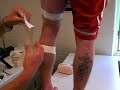 Knee Hyperextension Knee Hyperextension