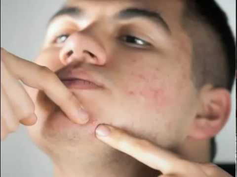 how to get rid of acne scars with home remedies