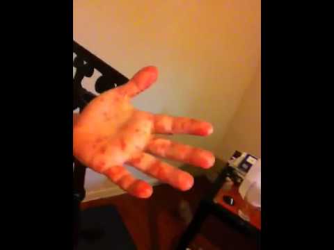 how to take care of hfmd