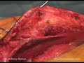 Scapulothoracic Fusion for Fascoscapulohumeral Muscular Dystrophy, Part 5 Scapulothoracic Fusion for Fascoscapulohumeral Muscular Dystrophy, Part 5