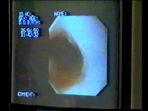 how to control ulcer