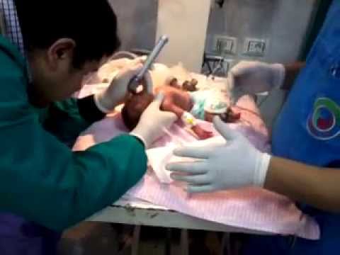 how to administer surfactant