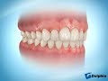 Orthodontic Positioner
