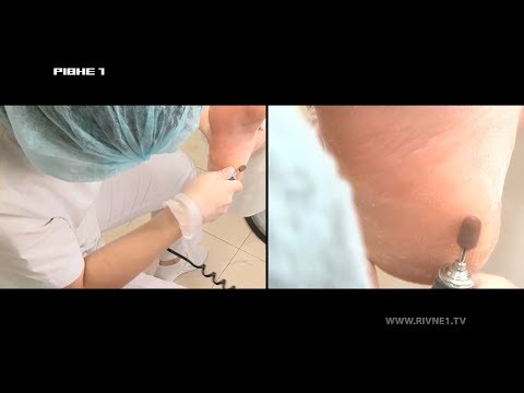 <a href='/Info/?id=82638' >Де у Рівному можна позбутися тріщин на п'ятах за одну процедуру - дивіться у програмі "Здорово жити"</a>