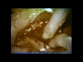 Army Medicine In Vietnam 1 - WARNING GRAPHIC WAR FOOTAGE