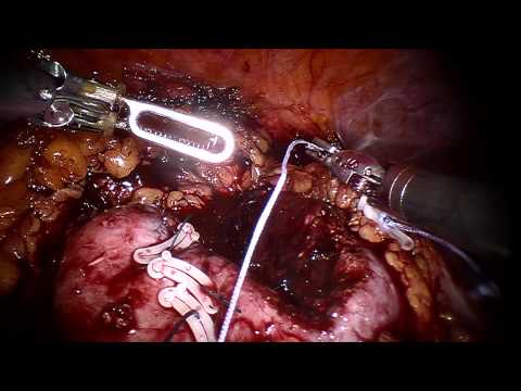 Dr. med. Georg Schön - 4DryField® PH in Partial Nephrectomy