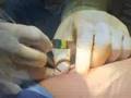 Saline breast implants fishers