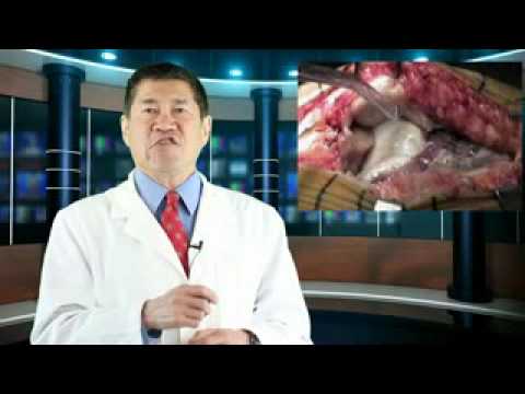 how to relieve pain after tkr