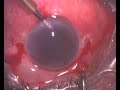 Endophthalmitis Vitrectomy + AC Wash + IV Antibiotic_Part1.flv