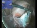 Laparoscopic Ovarian Cystectomy