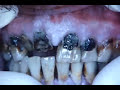 Meth Mouth-graphic pics