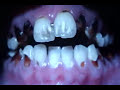 Meth Mouth-graphic pics
