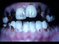 Meth Mouth-graphic pics