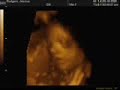 29 week Ultrasound
