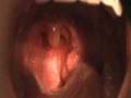 videos de what tonsilitis looks like
