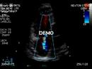 Echocardiogram - Conduit