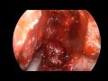 Endoscopic Skull Base Resection of Clival Tumor