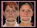 Derma Wand odos prie?i?ros prietaisas