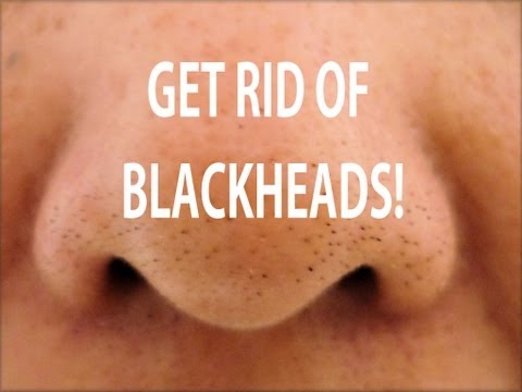 how to cure blackheads
