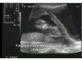 Baby George Ultrasound Footage Pro-Life Testimony Baby George Ultrasound Footage Pro-Life Testimony
