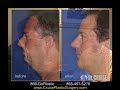 Neck Lift / Chin Implant / Rhinoplasty, Dr. Cruise