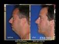 Neck Lift / Chin Implant / Rhinoplasty, Dr. Cruise