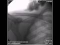 manual therapy of acromioclavicular joint by Prof K.pearlson