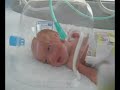 premature baby