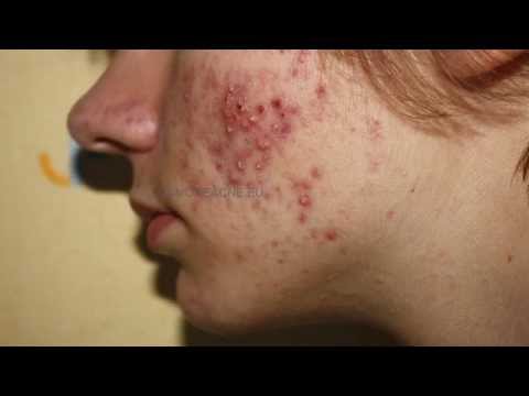 how to treat acne vulgaris