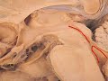 Neuroanatomy: Gross View @ Diencephalon Neuroanatomy: Gross View @ Diencephalon