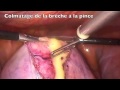 patiente consultant dans un tableau d'urgence avec douleurs brutales et très masse pelvienne à l' IRM ,allant d'une fosse iliaque à l'autre A la Coelioscopie Torsion d'annexe s'est faite autour du ligament lombo ovarien sur kyste enorme dermoide , ce qui peut engager rapidement le pronostic vital en cas de rupture docteur zemmouri najib gynecologue Rabat maroc