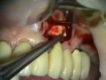 Endo/Perio Microsurgery: Lateral Canal Repair