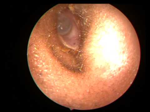 how to remove q tip cotton from ear