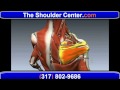 What exactly are the very best Choices for Coping with Shoulder Pain http://www.youtube.com/watch?v=WETY5l3_Hz8