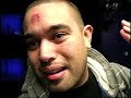 Forehead Hickey