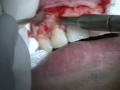 Cirurgia Paraendodontica (ABO) Parte 1