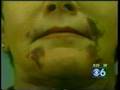 V-Beam for Cosmetic Surgery Bruising by Dr. Edwin Williams