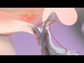 Ovulation & the menstrual cycle - Narrated 3D animation
