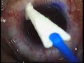 Cirug�a LASIK