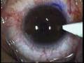 Cirugía LASIK