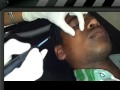 Sebaceous cyst removed by ellman RF by Dr Bhutada