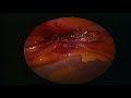 Umbilical Hernia Repair Umbilical Hernia Repair