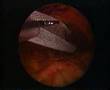 Umbilical Hernia Repair