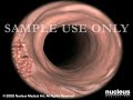 3D Medical Animation: Lower GI Colonoscopy (Sigmoidoscopy)