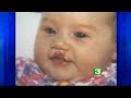 9-Year-Old Educates About Cleft Lip 9-Year-Old Educates About Cleft Lip