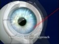 intralase bladeless lasik